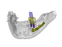 歯科用CTシミュレーションオペ1