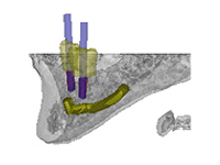 歯科用CTシミュレーションオペ2
