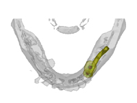 歯科用CTシミュレーションオペ3